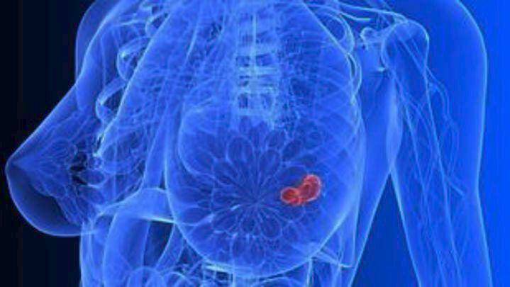 «Ένοχη» για καρκίνο του μαστού η ουσία ασπαραγίνη