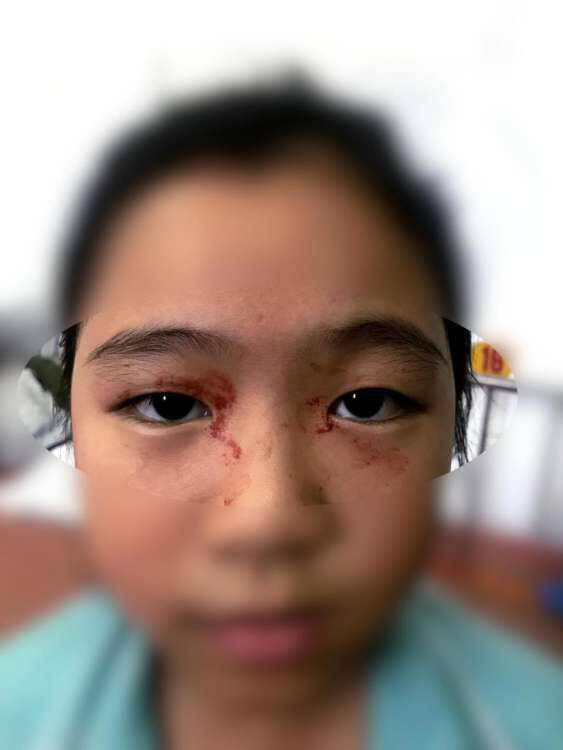 Η 11χρονη που ιδρώνει αίμα επειδή αγχώνεται