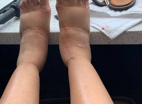Πασίγνωστη τραγουδίστρια έδειξε τα πρησμένα πόδια της στο Instgaram