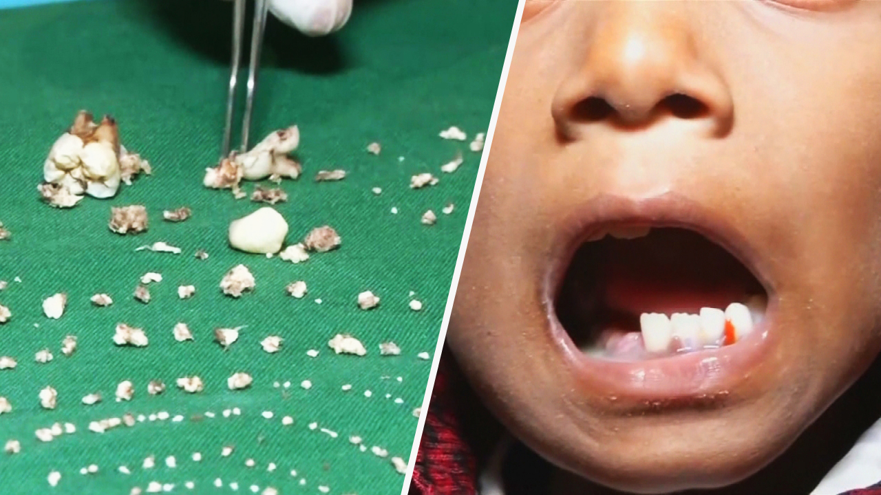 Ινδία: Γιατροί έβγαλαν 526 δόντια από το στόμα ενός 7χρονου (vid)