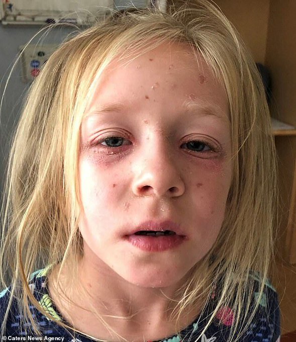 Κινδύνεψε η ζωή 8χρονης από τοξικό σοκ -Οι γιατροί νόμιζαν πως ήταν αλλεργία