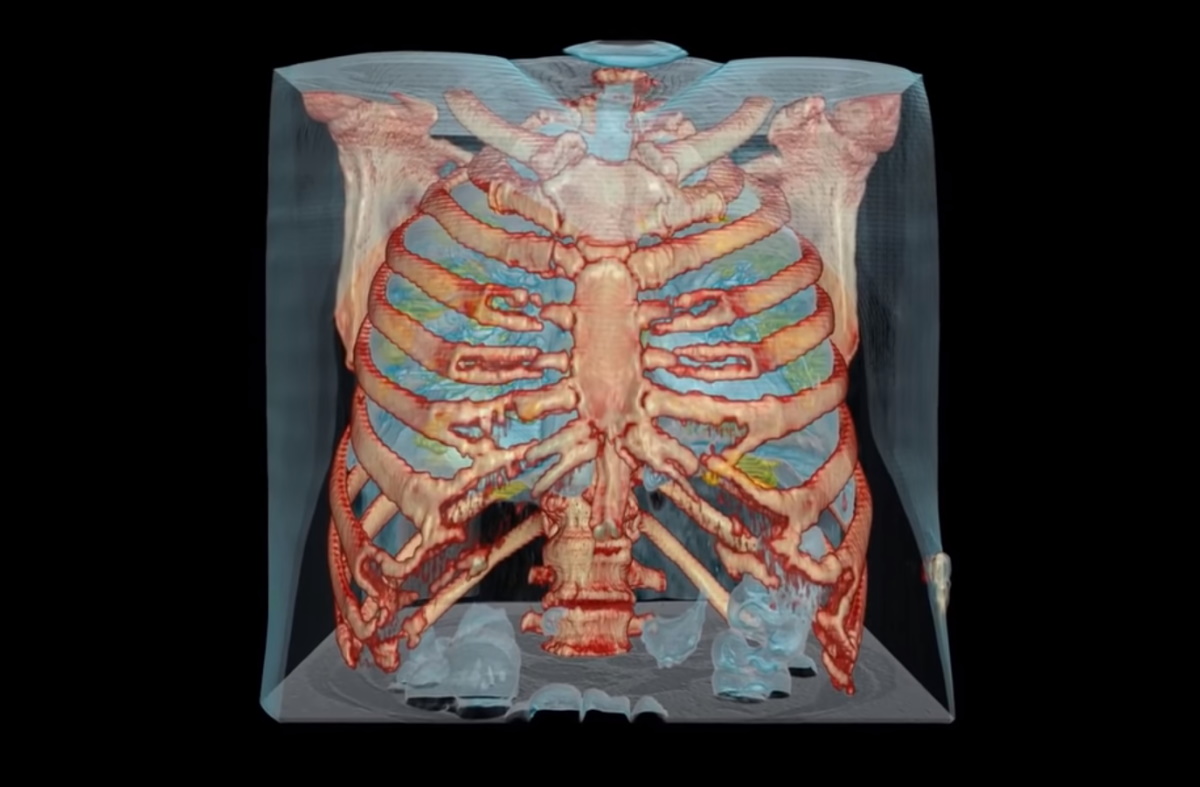 Κορονοϊός: Καρέ – καρέ οι βλάβες στους πνεύμονες σε video 3D!