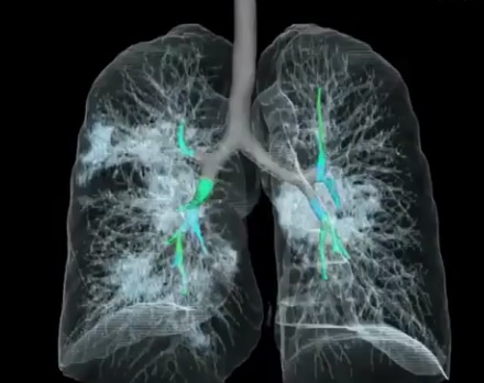 Κορονοϊός: Σοκαριστικό βίντεο! Έτσι «χτυπάει» τους πνεύμονες ασθενούς