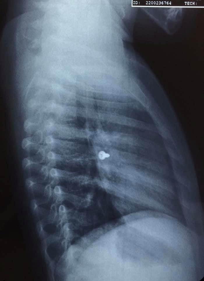 Κοριτσάκι 3 ετών στην Κρήτη κατάπιε βίδα και μπήκε εσπευσμένα στο χειρουργείο