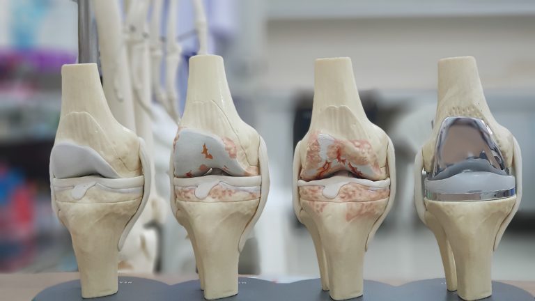 Ρομποτικά Υποβοηθουμένη Ολική Αρθροπλαστική Γόνατος