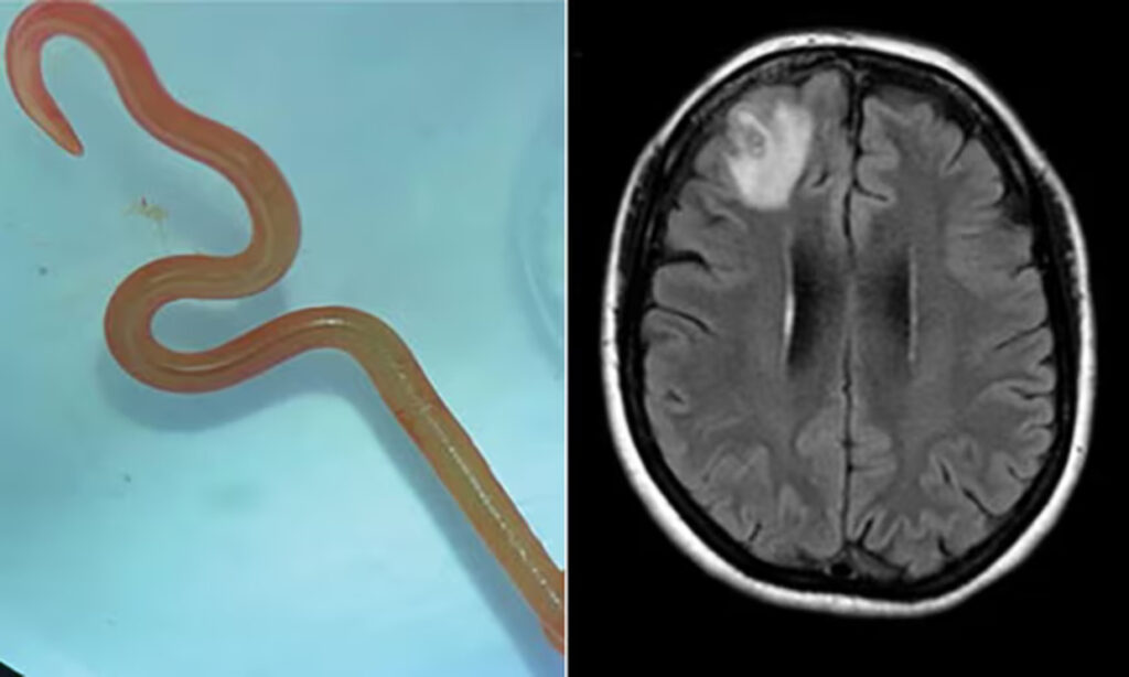 Ζωντανό σκουλήκι 8 εκατοστών βρέθηκε στον εγκέφαλο