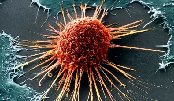 Έλληνες επιστήμονες «σκοτώνουν» τον καρκίνο και τις μεταστάσεις του, χωρίς αφαίρεση και χωρίς φάρμακα